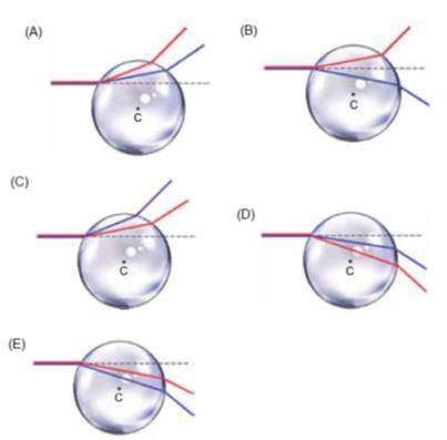 Alternativas para as trajetórias dos raios azul e vermelho na esfera